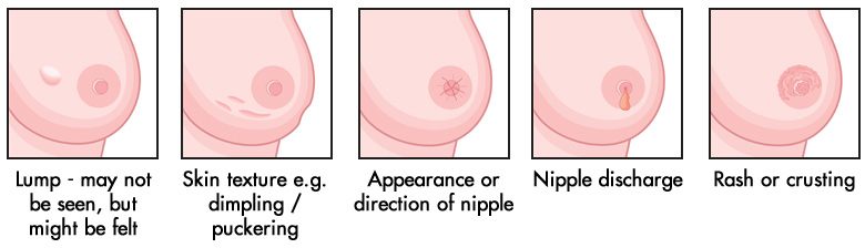 Understanding Breast Cancer