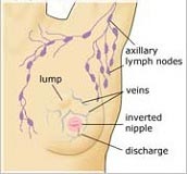 Symptoms of Breast cancer