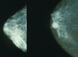 breast anatomy