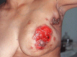 breast anatomy